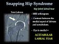 Snapping Hip Syndrome - Everything You Need To Know - Dr. Nabil Ebraheim