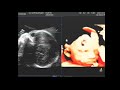 UC Baby Martin 3D Ultrasound