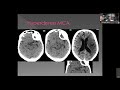 Stroke: The Role of CT and MRI in Diagnosis and Treatment