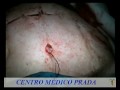 Centro Médico Prada - Abdominoplastia - Cirugía estética del abdomen
