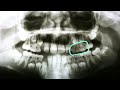 Adult teeth and baby teeth on a dental x-ray