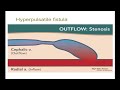 10-minute Rounds:  Outflow Stenosis and the Arteriovenous Fistula