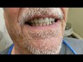 Denture Wax Try in visit