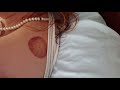 Recovering from blood cupping#hijama#wet  cupping! #2024 #afternoon #sunday #spirituality #relaxing