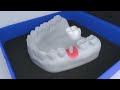 Procedimento Cirúrgico 3D - Arcsys Sistema de Implantes | FGM