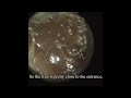 Earwax removal using WAXscope Earol prep weekly!