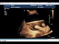 A level medical physics - ultrasound part 2  types of scan, A-scans, B-scans and M-scans