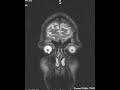 How to read an MRI of the brain | First Look MRI