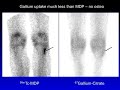 Essentials of Bone Scan - HD [Basic Radiology]