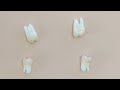 Wisdom teeth on dental x-ray and in real life