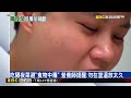 台東茂賓部落「生蝸牛小米粽」釀3死4命危！醫師示警：蝸牛寄生蟲多「一旦感染嚴重恐致命」@newsebc