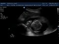 ultrasound 19 weeks