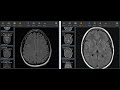 Chronic Microvascular Ischemic White Matter Disease of the Brain on MRI