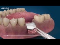 Dental Surgery Animation - Bone Grafting