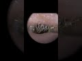 Hard matted ear wax removal with The WAXscope