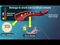 Understanding Type 2 Diabetes