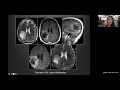 Imaging of  White Matter Lesions