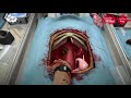 Surgeon Simulator: ep 2 kidney surgery