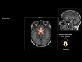 How To Read A Brain MRI - Neuroradiology Made Easy (Maybe?)