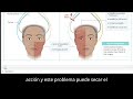 Paralisis facial Perifèrica o de Bell. Resumen USMLE