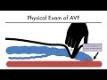 Hemodialysis Access 101 03 - Physical Exam of AVF