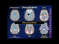 ⚕️ Making Sense of White Matter Disease by James G. Smirniotopoulos, M.D.