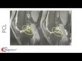 Read Knee MRI ACL and PCL - Help with Reading MRI