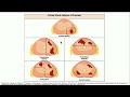 Focal Therapy in Prostate Cancer: Is it Ready for Prime Time?