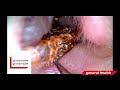 Earwax Removal eps15