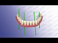 Smart Denture Conversions Protocol by Avadent