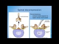 Lumbar Spinal Stenosis : Diagnosis and Treatment Options