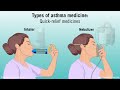 Understanding Asthma: Mild, Moderate, and Severe