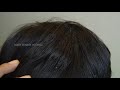 Remove Big Dandruff Flakes On Front Side!!! Dandruff Scratching Satisfying #293