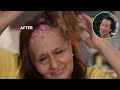 Plastic Surgeon Reacts to DR. PIMPLE POPPER! 100 Masses On Her Head!