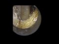 Quick ear wax removal with WAXscope