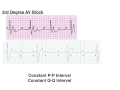 AV Blocks (1st, 2nd, and 3rd Degree)