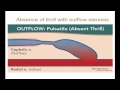 10-minute Rounds:  Physical Examination of the Arteriovenous Fistula
