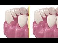 How to prevent a dry socket and bone loss after tooth extraction?