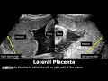 Placenta Positions On Ultrasound | Anterior/Posterior/Fundal/Lateral Placental Positioning USG