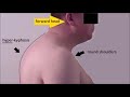 Head and Neck Posture - One Man's Story of the Stigma