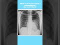 What to do if you suspect a pneumothorax (but can't find it) #shorts