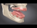 Devastating Consequences of Tooth Loss- Bone Loss Visual