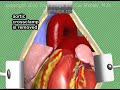 Aortic Valve Replacement Surgery Animation by Cal Shipley, M.D.