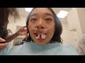 GETTING MY WISDOM TEETH REMOVED | vlog & recovery process! *hilarious*