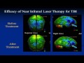 Can near-infrared energy reach the brain for treatment of TBI? - Video abstract [78182]