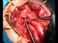 Time lapse of male to female sexual reassignment surgery.