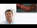 Venous Ulcers by Dr. Saurabh Jain, Wound Care Surgeon