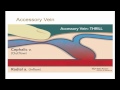 10-minute Rounds:  Accessory Vein and the Arteriovenous Fistula
