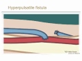 Physical Examination of Arteriovenous Fistula