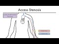 Hemodialysis Access 101 04 - Part 1: Access Stenosis